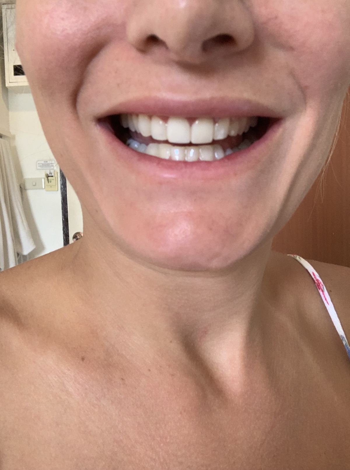 3 weeks after veneers were fitted on my teeth