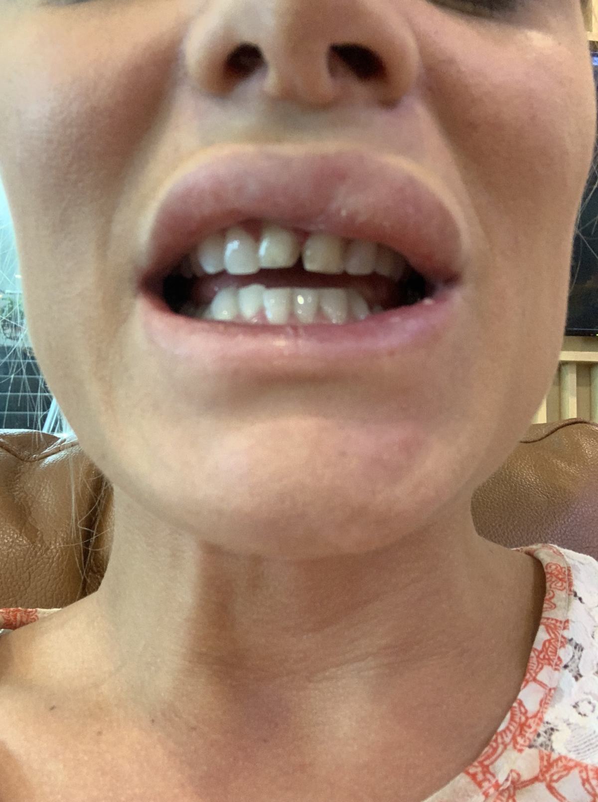 My two front teeth getting prepped for veneers